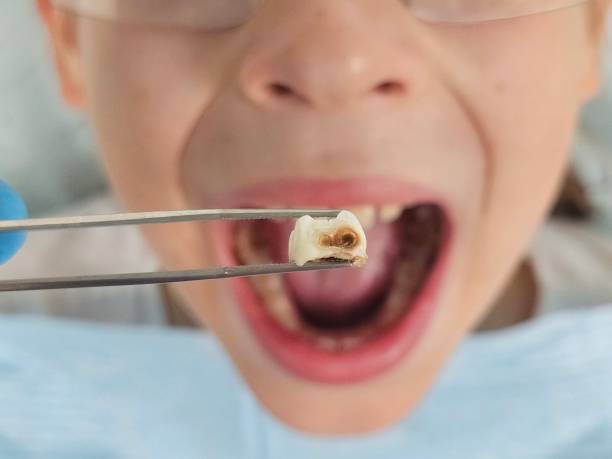 Emergency Dental Filling Replacement in KS